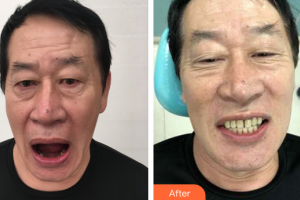 廣州市荔灣區(qū)口腔醫(yī)院謝思明整形價格表附種植牙案例展示