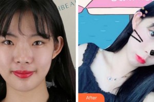 杭州格萊美整形美容醫(yī)院姚建民整形價(jià)格表附熱瑪吉案例展示