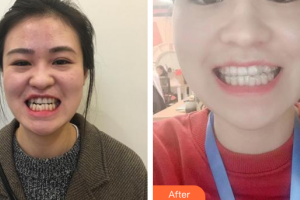 廣州市荔灣區(qū)口腔醫(yī)院任柏林整形價格表附隱形牙齒矯正案例展示