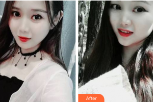 廣州愛康健口腔門診部黃茲谷整形價格表附牙齒隱形矯正案例展示