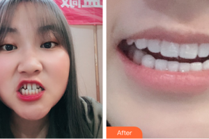 廣州市荔灣區(qū)口腔醫(yī)院區(qū)展鵬整形價格表附瓷貼面案例展示