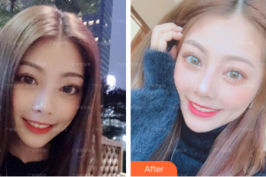 廣州市荔灣區(qū)口腔醫(yī)院王志偉整形價格表附牙齒美白案例展示