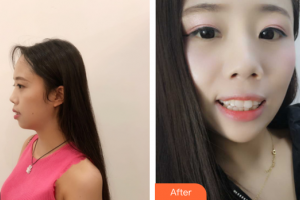 廣州市荔灣區(qū)口腔醫(yī)院崔亞琪整形價格表附牙齒矯正案例展示