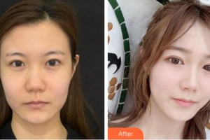 杭州瑞麗整形醫(yī)院劉波整形價(jià)格表附熱瑪吉案例展示
