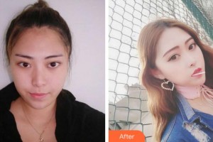 杭州珍美顏醫(yī)療美容診所陳永整形價(jià)格表附鼻部綜合案例展示