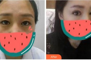 杭州東方整形外科門(mén)診部黃發(fā)明整形價(jià)格表附切開(kāi)雙眼皮案例展示