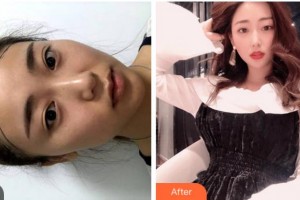 杭州新生毛發(fā)種植研究院曾令國(guó)整形價(jià)格表附種植發(fā)際線案例展示