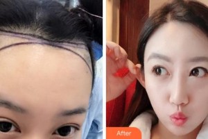 杭州新生毛發(fā)種植研究院甘柳明整形價(jià)格表附種植發(fā)際線案例展示