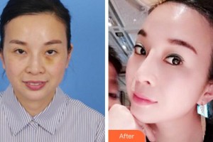 杭州時(shí)光醫(yī)療美容醫(yī)院鄒芥整形價(jià)格表附埋線提升案例展示