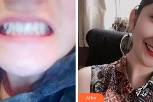 杭州時(shí)光醫(yī)療美容醫(yī)院葉學(xué)功整形價(jià)格表附牙齒陶瓷矯正案例展示