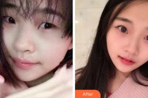 杭州瑞麗整形醫(yī)院徐少駿整形價(jià)格表附切開(kāi)雙眼皮案例展示