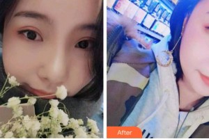 杭州瑞麗整形醫(yī)院林莉整形價(jià)格表附牙齒隱形矯正案例展示