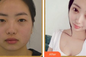 杭州藝之花醫(yī)療美容醫(yī)院楊海波整形價(jià)格表附眼部綜合案例展示