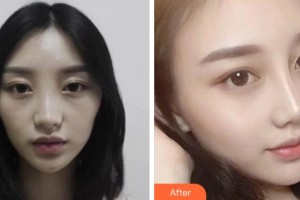 杭州格萊美整形美容醫(yī)院崔順宇整形價格表附鼻部綜合案例展示