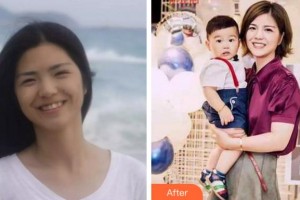 杭州格萊美整形美容醫(yī)院許水華住院醫(yī)師整形價格表附牙齒隱形矯正案例展示