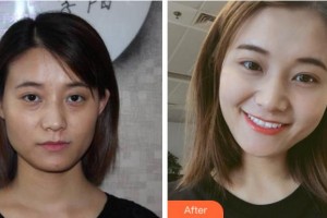 杭州愛琴海醫(yī)療美容醫(yī)院程磊整形價格表附埋線提升案例展示