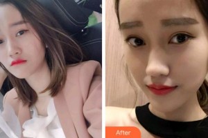 杭州愛琴海醫(yī)療美容醫(yī)院胡旭東整形價格表附牙齒隱形矯正案例展示