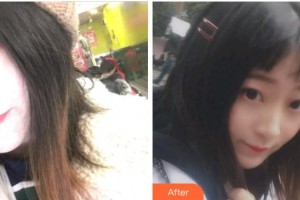 杭州時光醫(yī)療美容醫(yī)院金楨粲整形價格表附金屬托槽矯正案例展示