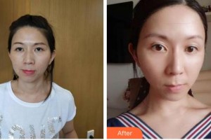 杭州珈禾整形美容醫(yī)院鄧華整形價格表附熱拉提案例展示