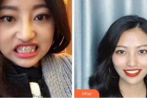 杭州華山連天美醫(yī)療美容整形醫(yī)院郭桂云整形價格表附牙齒陶瓷矯正案例展示