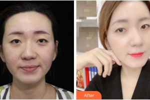 杭州華山連天美醫(yī)療美容整形醫(yī)院李艷霞整形價格表附熱拉提案例展示