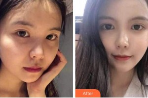 杭州華山連天美醫(yī)療美容整形醫(yī)院梅國瑞整形價格表附熱瑪吉案例展示