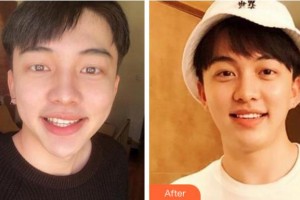 杭州華山連天美醫(yī)療美容整形醫(yī)院顧閱整形價格表附美白貼片案例展示