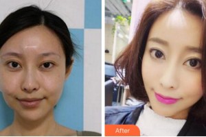 杭州整形醫(yī)院孫豪整形價格表附埋線提升案例展示