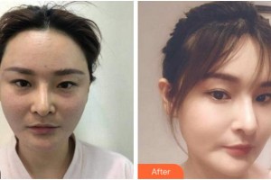 杭州整形醫(yī)院田楓整形價格表附埋線提升案例展示