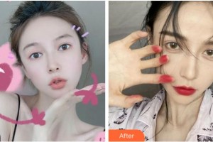 杭州整形醫(yī)院沈劍整形價格表附耳軟骨復合隆鼻案例展示