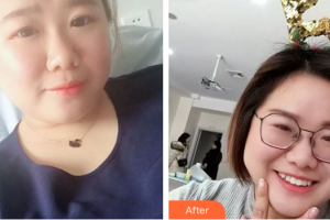 廣州市荔灣區(qū)口腔醫(yī)院司徒燕整形價格表附牙齒隱形矯正案例展示