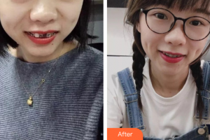 廣州市荔灣區(qū)口腔醫(yī)院溫興濤整形價格表附金屬托槽矯正案例展示