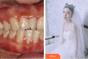 廣州市荔灣區(qū)口腔醫(yī)院張沛整形價格表附牙齒隱形矯正案例展示