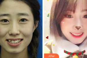 廣州嘉美口腔門診部宛敏整形價格表附金屬托槽矯正案例展示