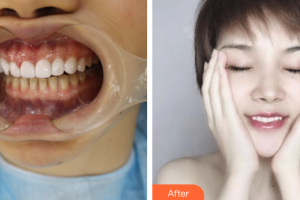 廣州嘉美口腔門診部陳星整形價格表附牙齒貼面案例展示