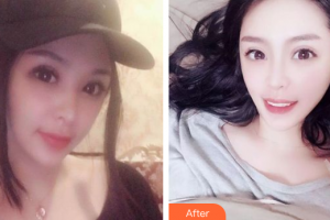 廣州梅里奧口腔門診部王鴻烈整形價格表附牙齒隱形矯正案例展示