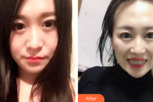 廣州梅里奧口腔門診部馮銳整形價格表附金屬托槽矯正案例展示