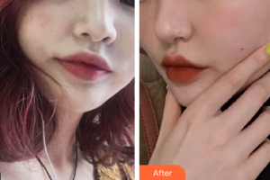 廣州美博匯醫(yī)療美容門診部胡春艷整形價格表附激光美膚激光案例展示