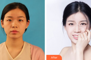 廣州美博匯醫(yī)療美容門診部章鏵予整形價格表附眼部綜合案例展示