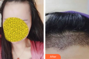 廣州美博匯醫(yī)療美容門診部趙新整形價格表附種植發(fā)際線案例展示