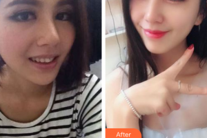 廣州宸山醫(yī)療美容門診部朱健海整形價格表附金屬托槽矯正案例展示