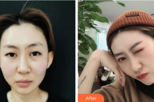 杭州啟美醫(yī)療美容醫(yī)院黃偉杰整形價格表附埋線提升案例展示