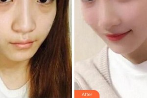 杭州啟美醫(yī)療美容醫(yī)院嚴志平整形價格表附埋線提升案例展示