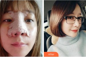 杭州蕭山區(qū)第一人民醫(yī)院整形燒傷科盧力整形價格表附鼻部綜合案例展示