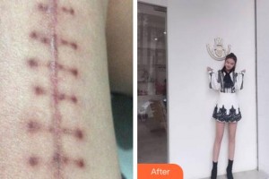 杭州蕭山區(qū)第一人民醫(yī)院整形燒傷科王定國整形價格表附微創(chuàng)疤痕修復案例展示