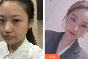 杭州藝星醫(yī)療美容醫(yī)院柏亞萍整形價格表附激光祛斑案例展示