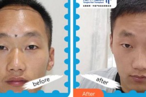 杭州科發(fā)源帝麥整形醫(yī)院李興東整形價(jià)格表附植發(fā)養(yǎng)發(fā)案例展示