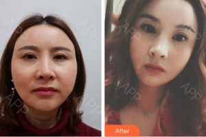 杭州瑞麗整形醫(yī)院吳艾競(jìng)整形價(jià)格表附埋線提升案例展示