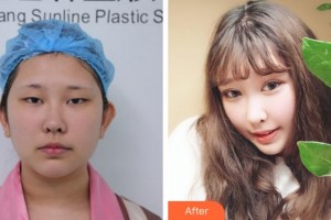 杭州格萊美整形美容醫(yī)院孫商燮整形價(jià)格表附切開雙眼皮案例展示