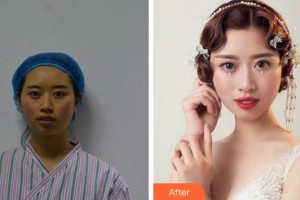 杭州格萊美整形美容醫(yī)院王雪瑞整形價(jià)格表附埋線提升案例展示